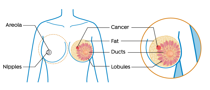 Diagram of a female with breast cancer